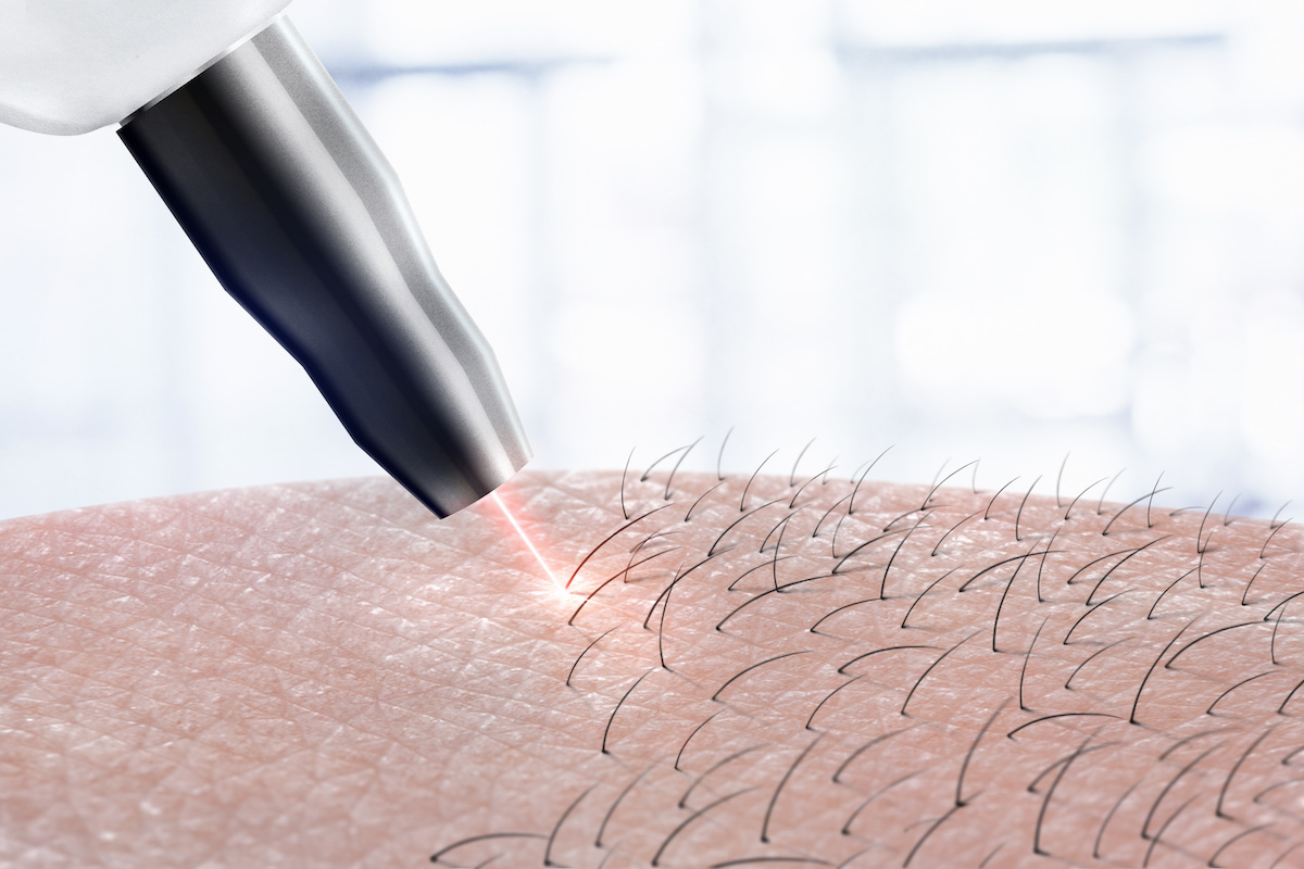 Laser Hair Removal Series: How to Prepare? - Hillandale Primary Care